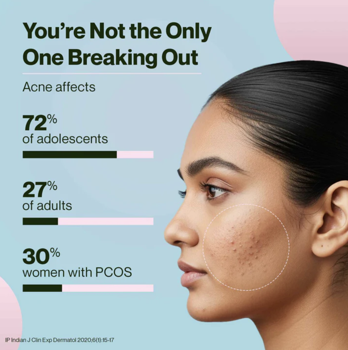 Acne statistics showing prevalence in adolescents, adults, and women with PCOS