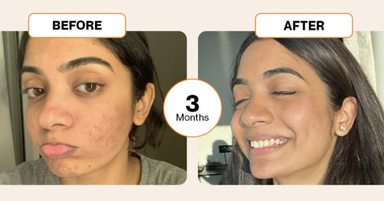 Before and After using Setu Radiant Skin - Priya M, Mumbai